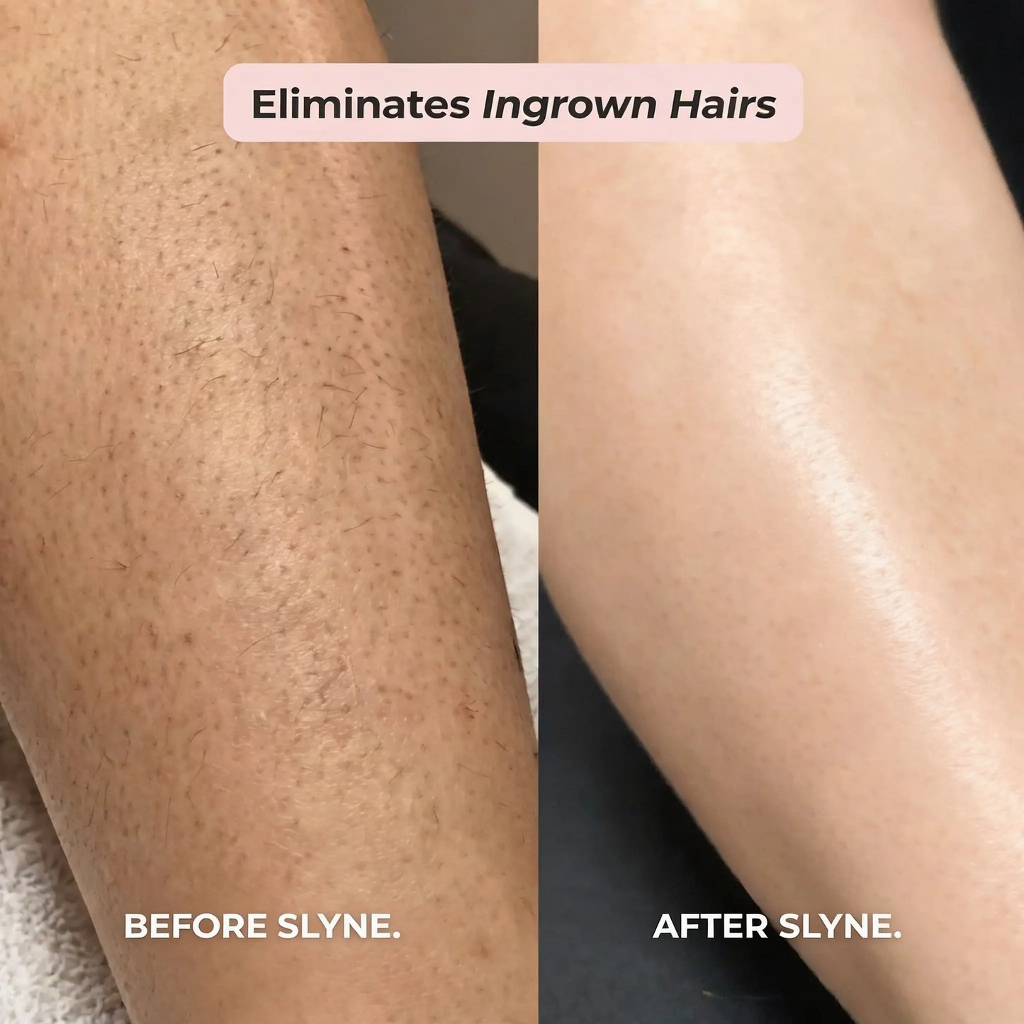 SLYNE™ 2-IN-1 BIKINI & BODY RAZOR